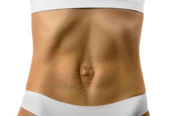 diastasis recti treatment