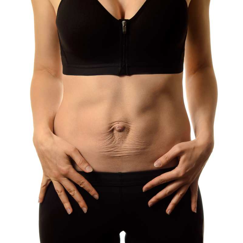 diastasis Recti treatment