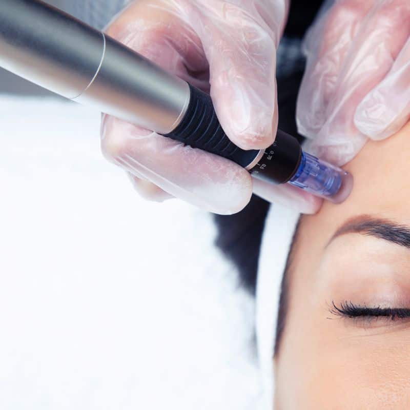 Morpheus8 treatment Bridgnorth from Lipo Sculpt - Book in today!