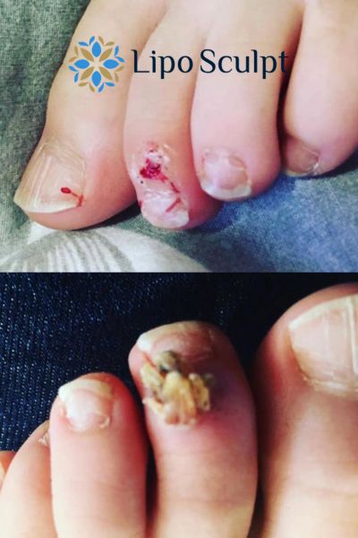 Wart removal customer results from Lipo Sculpt Bridgnorth