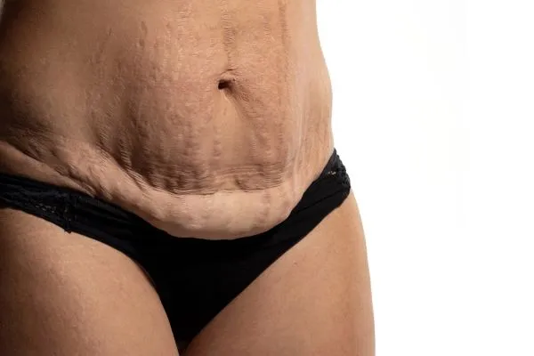 Lost the Weight but Not the Loose Skin? 1 image of womans stomach after weight loss showing loose skin Bridgnorth